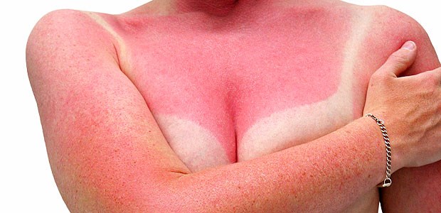 Sonnenbrand bald schmerzfrei? Sonnenbrand: Würde eine Creme, die die Schmerzen lindert, den Sonnenhungrigen nur Nutzen bringen?