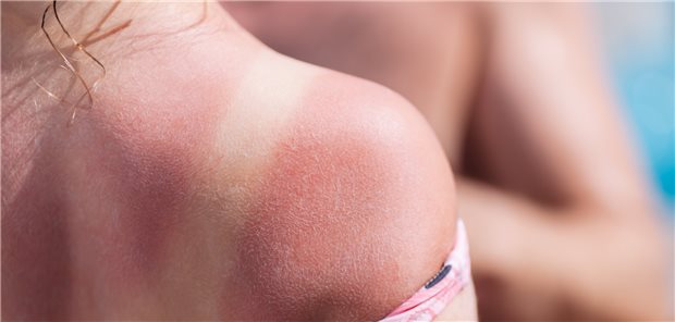 Sonnenbrand an Rücken und Schulter: Sowohl das Lebenszeitrisiko für ein Melanom als auch das für ein Plattenepithelkarzinom scheinen sehr stark von der Zahl der Sonnenbrände in der Kindheit abzuhängen.

