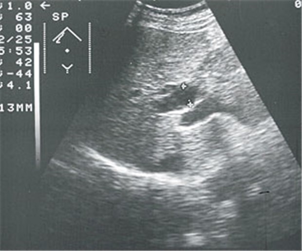 Tipps zur Nachsorge beim Pankreaskarzinom Sonografie-Bild eines erweiterten Ductus choledochus bei Pankreaskarzinom.