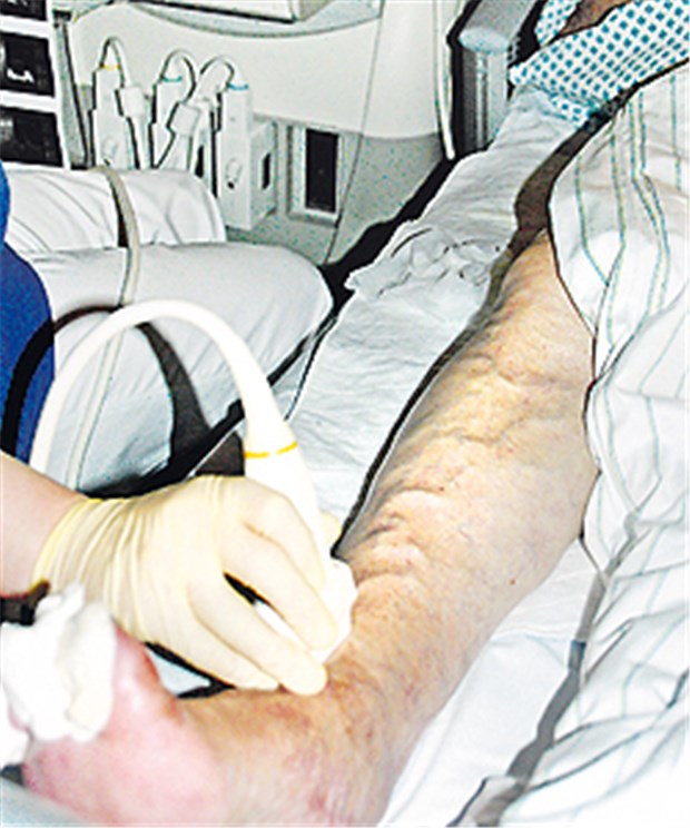 Vorteile bei Venenthrombose Sonografie bei Unterschenkelthrombose.