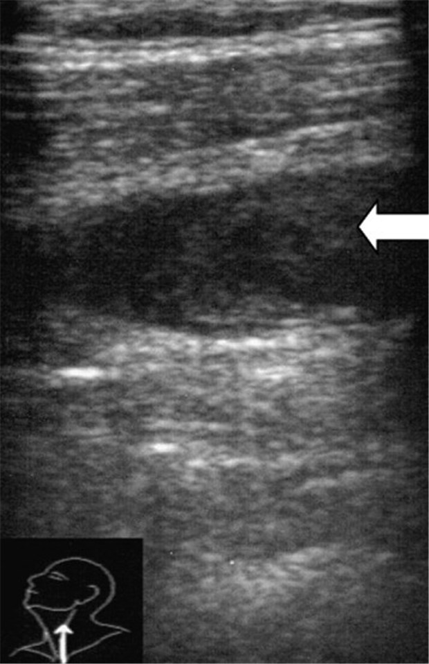 Sonografie der Thrombose in einer vergrößerten Aufnahme.