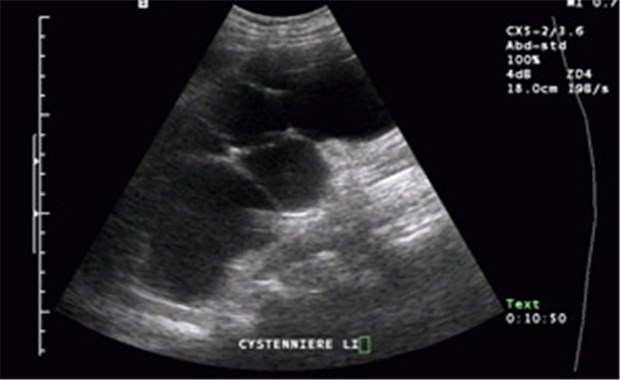 Immunsuppressivum bei Zystenniere getestet Sonografie einer Zystenniere links. Das Funktionsgewebe (Parenchym) ist fast vollständig durch Zysten (dunkel) zerstört.