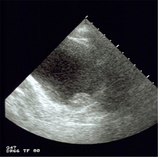 Einfacher Urintest deckt Blasenkrebs frühzeitig auf Sonografie eines Urothelkarzinoms: Diese bereits sichtbare Erkrankung soll anhand eines einfachen Urintests früher diagnostiziert werden können.
