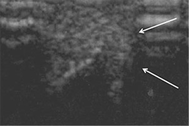 Bei 9 mg/dl muss die Harnsäure immer runter Sonografische Darstellung der 12 mm durchmessenden Fingerkuppenläsion mittels 7-MHz-Sonografie.