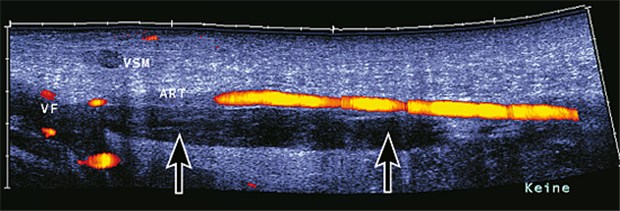 Sonografische Darstellung der Vena femoralis (VF). Binnenechos im Lumen (Pfeile) zeigen eine Thrombose an.