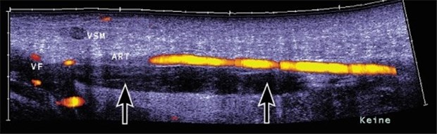 "Nach dem Klinikaufenthalt darf keine Lücke in der Thrombose-Prophylaxe entstehen" Sonogramm der V. femoralis. Pfeile zeigen eine Thrombose an.