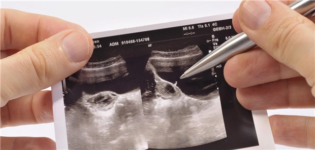 Sonogramm von einer Patientin mit Ovarialzyste: Nur bei komplexen Zysten und solider Raumforderung ist das Krebsrisiko erhöht.