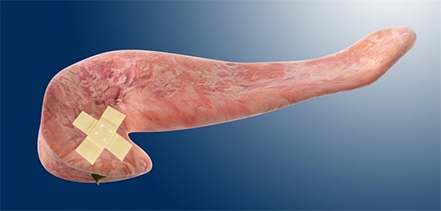 Neue Therapieansätze bei Pankreaskarzinom Sorgenkind Pankreaskrebs: Das duktale Adenokarzinom des Pankreas erweist sich als hartnäckig gegenüber zielgerichteten und immunologischen Therapieansätzen.