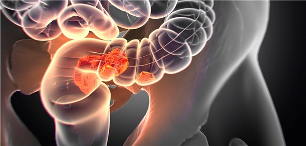 Sowohl die Entwicklung und Wiederkehr kolorektaler Adenome als auch ihre Progression zu einem Kolorektalkarzinom scheinen NSAR zu verhindern.