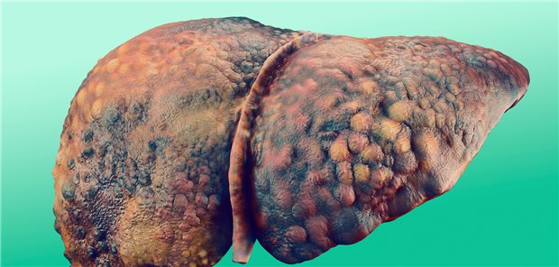 Spätfolge einer unbehandelten Hepatitis-C-Infektion: die Leberzirrhose.