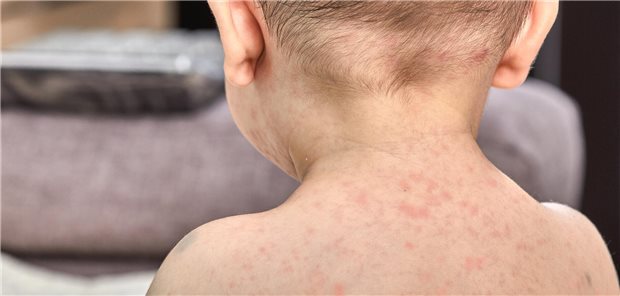Spätreaktionen einer Antibiotikaallergie treten erst nach Tagen auf, typisch sind Hautausschläge ohne schwere systemische Reaktionen (unkomplizierte makulopapulöse Exantheme, MPE).