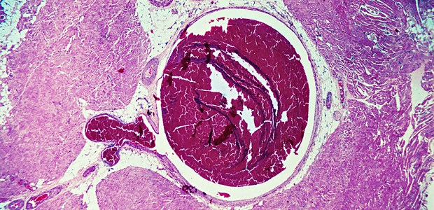 Neue Leitlinie zur Thromboseprophylaxe Stationär behandelte Patienten mit einer aktiven Erkrankung haben ein hohes Thromboembolierisiko.