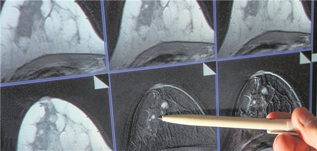 Abemaciclib zur adjuvanten Therapie des HR+ Mammakarzinoms empfohlen Ein Tumor ist in einer MRT-Aufnahme sichtbar.