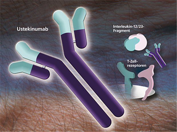 Stelara® (Ustekinumab) bremst Immunreaktionen bei Plaque-Psoriasis. © Janssen-Cilag / Photos.com