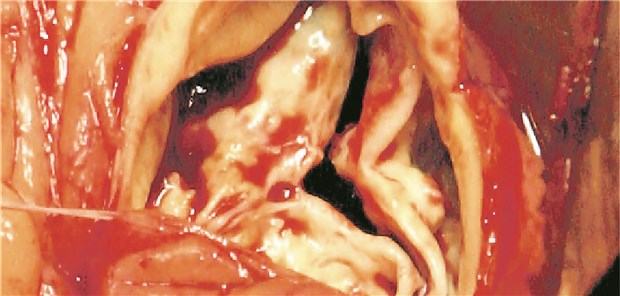 Plötzlicher Herztod häufiger als gedacht Stenose der Aortenklappe: In Leitlinien wird bei asymptomatischen Patienten zum „watchful waiting“ geraten.