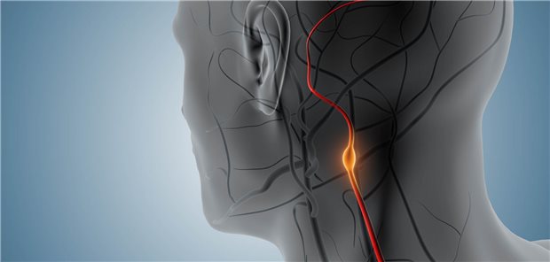 Dreidimensionale Illustration einer Karotisstenose im Halsbereich eines Mannes.