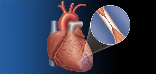 Stenose in der Koronararterie: Welche Therapie verspricht die beste Prognose?