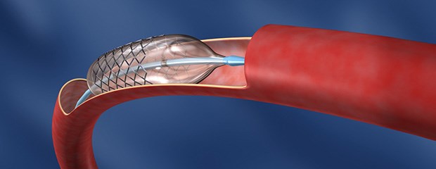 Ohne ASS weniger Todesfälle Stent-Implantation: Braucht es ASS, wenn bereits eine orale Antikoagulation gegeben wird?