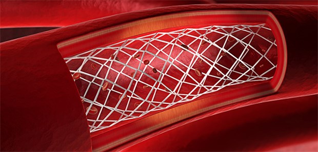 Stent – eine Option, um bei koronarer Herzkrankheit die Durchblutung wiederherzustellen.