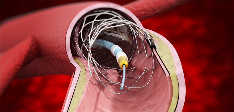 Neue Analyse spricht für Bypass statt Stent
