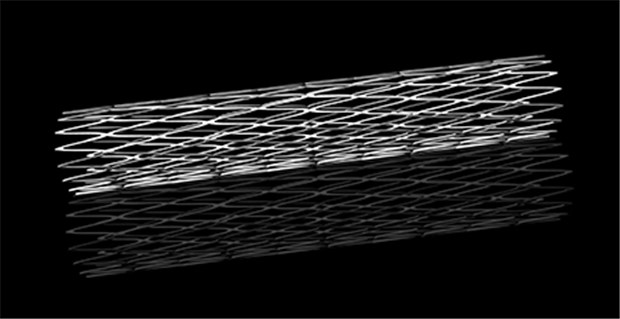 Weltrekord? Ein KHK-Patient mit 67 Koronarstents Stents, kleine hilfreiche Metallgitter - aber gleich 67 davon?