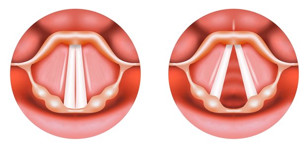 Stimmlippen im Fokus: Bei einer Lähmung gibt es vielfältige Interventionsmöglichkeiten.