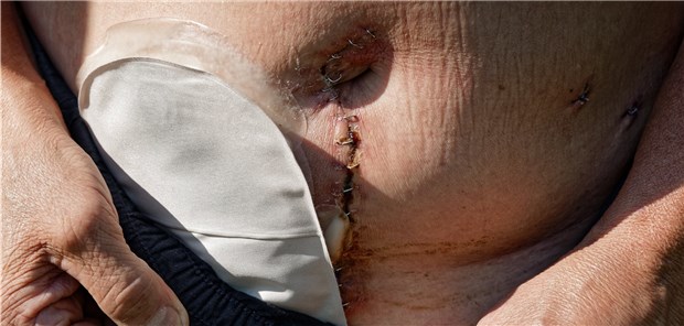 Stoma – ein nach wie vor umkämpfter Markt.