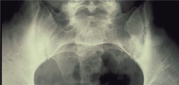 Strukturelle Veränderungen an der Wirbelsäule bei axialer Spondyloarthritis: Sie können durch eine NSAR-Therapie hinausgezögert werden.