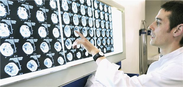 Subarachnoidalblutung: Aktive Raucher haben im Mittel ein rund dreimal so hohes Risiko für eine tödliche SAH wie Nichtraucher.