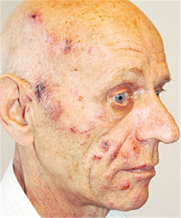 Capsaicin lindert Schmerz