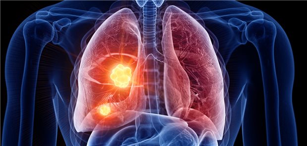 NSCLC: Pembrolizumab bei Personen mit Diabetes weniger wirksam Symbolbild
