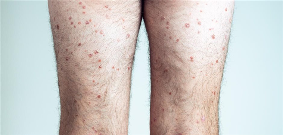Neuer Therapieansatz gegen Prurigo nodularis