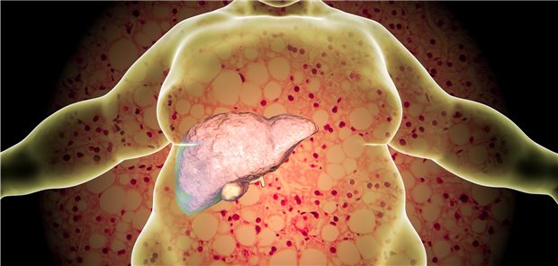 Adipositas und Fettleber: Eine halbe Million Menschen sind in Deutschland von NASH betroffen.