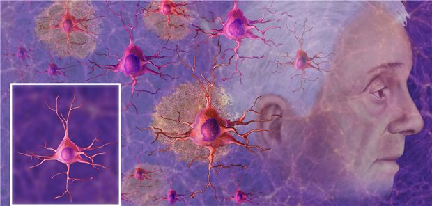 Symbolbild Alzheimer: Amyloid-Plaques lassen Neuronen absterben. Der gegen das Amyloid gerichtete Antikörper Solanezumab hat die Akkumulation von Beta-Amyloid nicht stoppen können.
