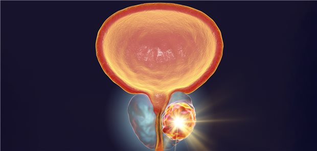 Prostata mit Karzinom, Computerdarstellung