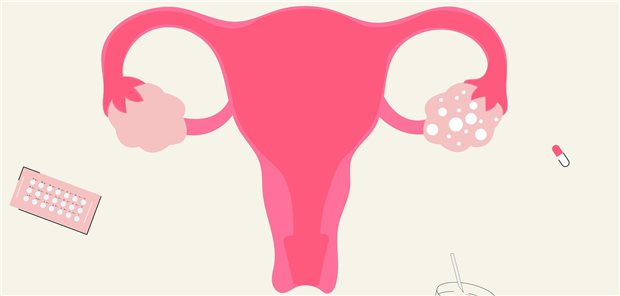 Symbolbild für das Polyzystische Ovar-Syndrom; im rechten Ovar sind die Zysten hervorgehoben. 