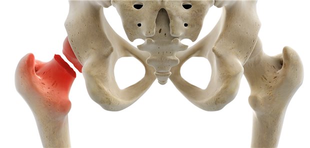 Symbolische Darstellung einer Fraktur