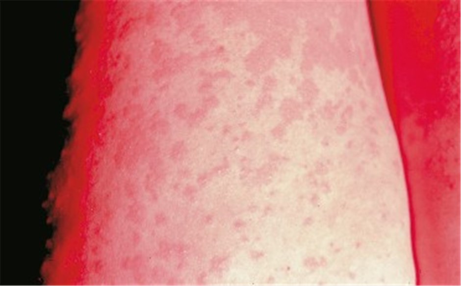Wie Sieht Der Ausschlag Bei Hiv Aus