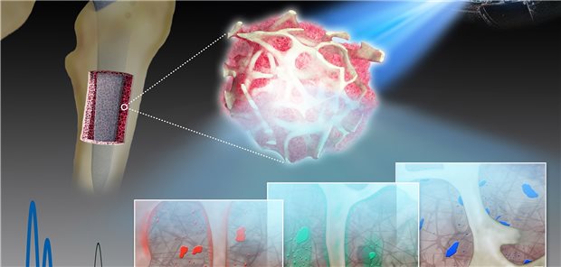 Synchrotron-Röntgenfluoreszenzanalyse der Knochenproben: Im Bild unten dargestellt sind die spezifischen Verteilungsmuster von Kobalt (rot), Chrom (grün) und Titan (blau), die aus den Endoprothesen freigesetzt werden und sich im Knochen anreichern.