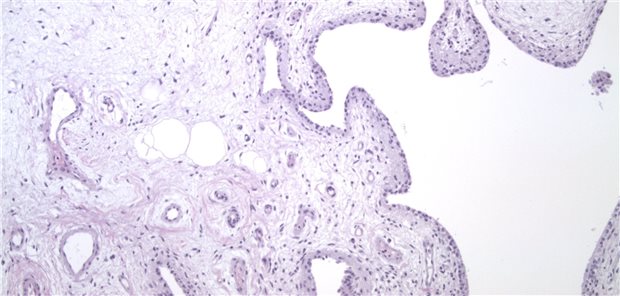 Synovialitis – hier unter dem Mikroskop: Low-grade-Synovialitis mit leichtgradiger entzündlicher leukozytärer Infiltration (Vergrößerung etwa 200:1). 