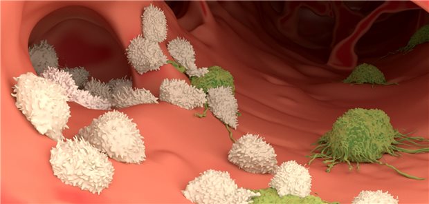 T-Lymphozyten greifen wandernde Krebszellen an.