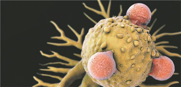 CAR-T-Zellen sind auch eine Option für Patienten mit Glioblastom T-Lymphozyten haben sich an eine Krebszelle geheftet.