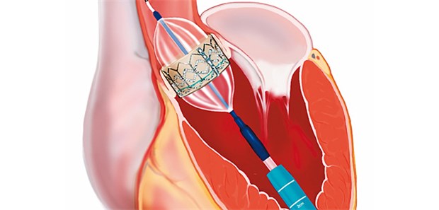 Mit TAVI-Therapie leben Senioren länger TAVI-Methode: Die neue Aortenklappe wird mit einem Herzkatheter in Position gebracht.