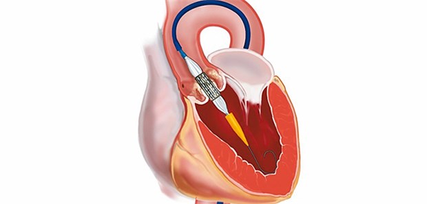 Rückenwind für Katheter-Aortenklappen TAVI-Methode zum Aortenklappenersatz: Die neue Aortenklappe wird mit einem Herzkatheter in Position gebracht.