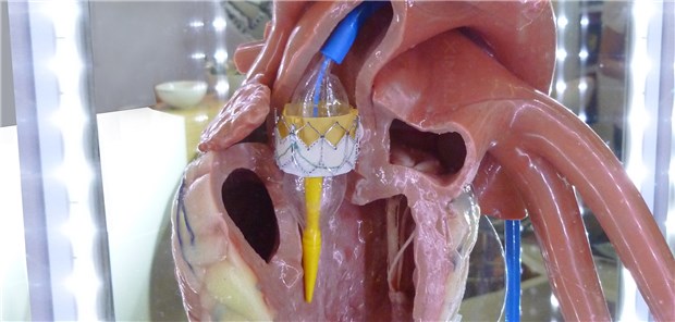 TAVI-Modell mit Sapien-Klappe von Edwards; bisher werden bei der TAVI die Klappensysteme im Alltag weitgehend austauschbar eingesetzt. 