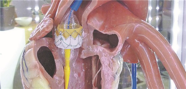 TAVI im Modell: Durch den katheterbasierten Eingriff konnte der Klinikaufenthalt im Vergleich zur Op signifikant verkürzt werden.