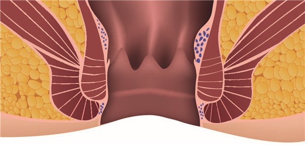 Tabu-Zone Analbereich (hier mit leichten Hämorrhoiden dargestellt). Patienten mit einem früh erkannten Karzinom in diesem Bereich haben heute eine recht gute Prognose.