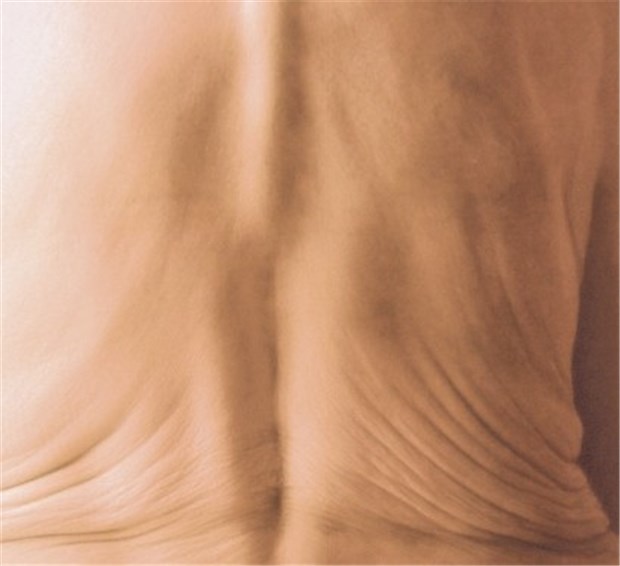 Raloxifen lohnt auch als Zweittherapie Tannenbaumphänomen bei einer Osteoporose-Patientin infolge von Wirbelkörperfrakturen.