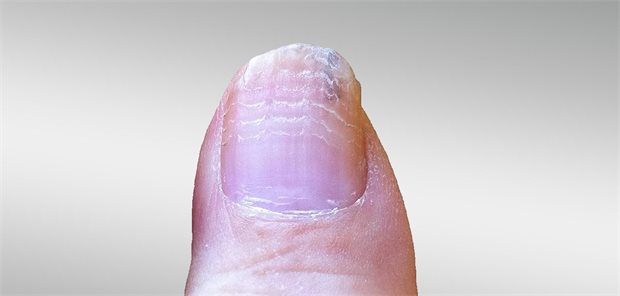 Foto eines Nagels mit weissen Querrillen.
