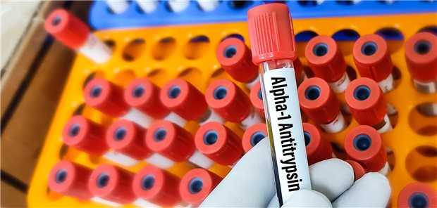 Test auf Alpha-1-Antitrypsin: Ein Mangel fördert die Entstehung eines Lungenemphysems.